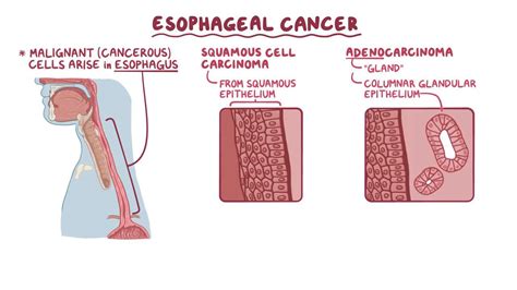 esophageal adenocarcinoma vs squamous cell